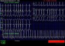 Ps plemena:  > Fibrilace sn (Veterinrn zkroky)